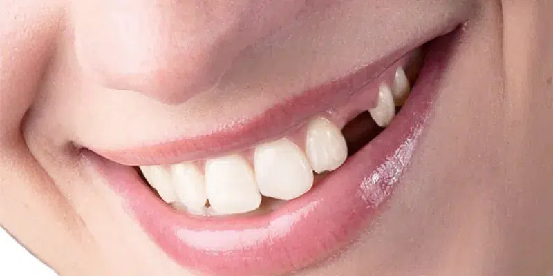 Ý nghĩa của giấc mơ thấy rụng răng
